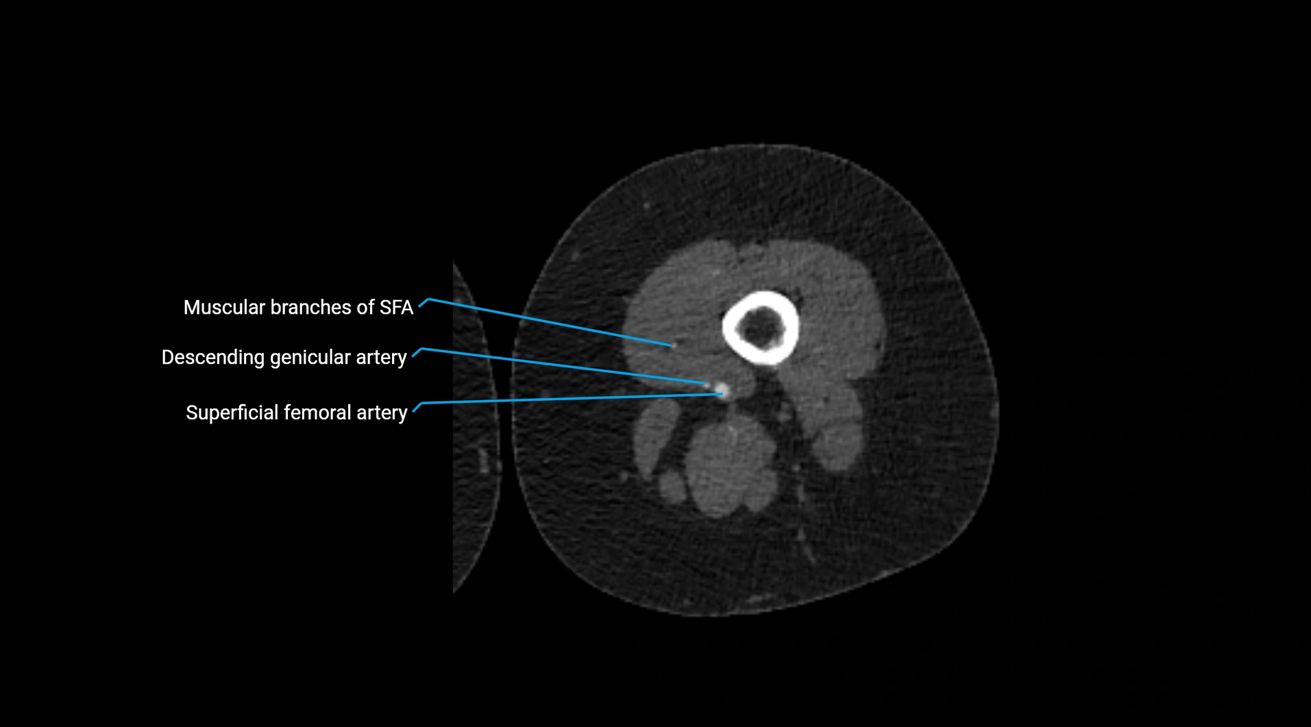 CTA lower limb cross sectional anatomy labelled image _146.webp